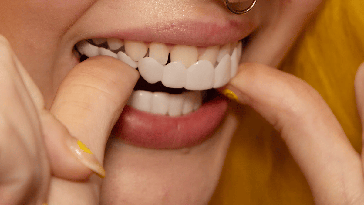Snap on Smile Veneers (Ober- & Unterkiefer)