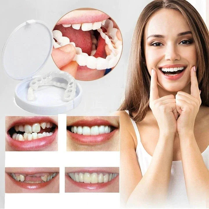 Snap on Smile Veneers (Ober- & Unterkiefer)