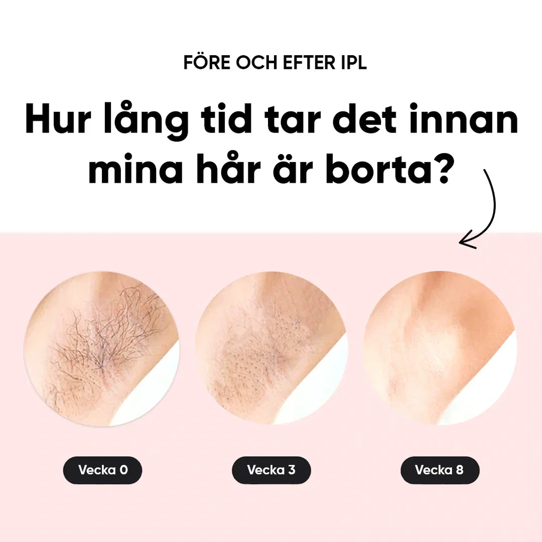 IPL - Épilation permanente