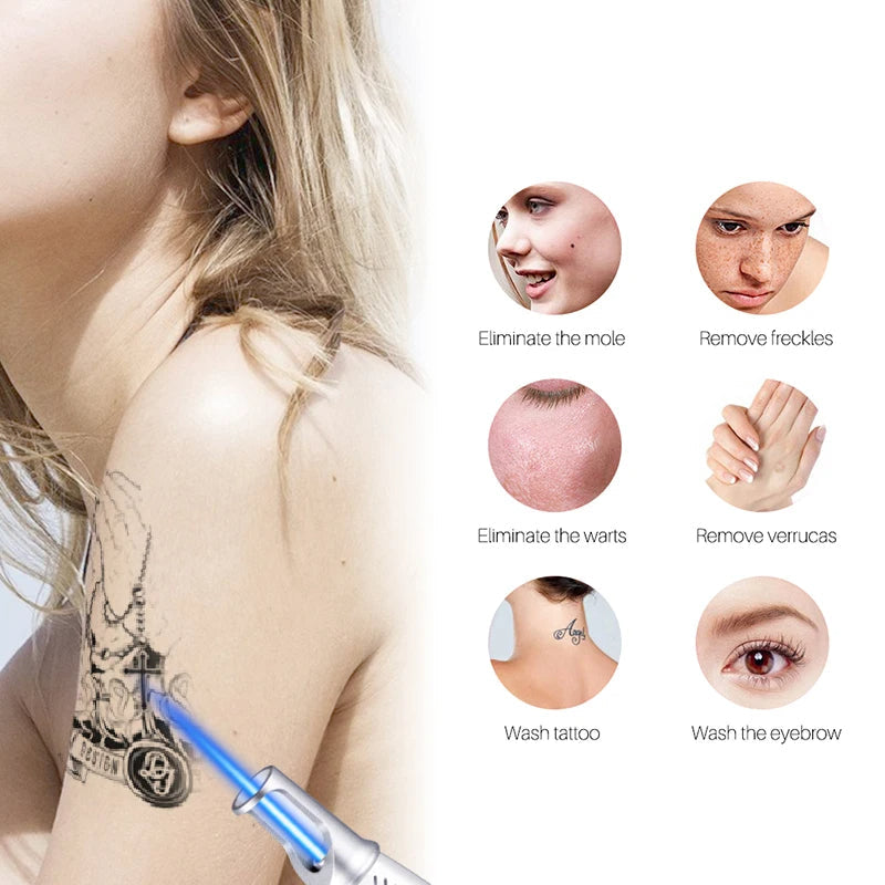 Intelligenter Tattoo-Entfernungs-Laserstift - Entfernt Muttermale, Sommersprossen, Akne, Tattoos