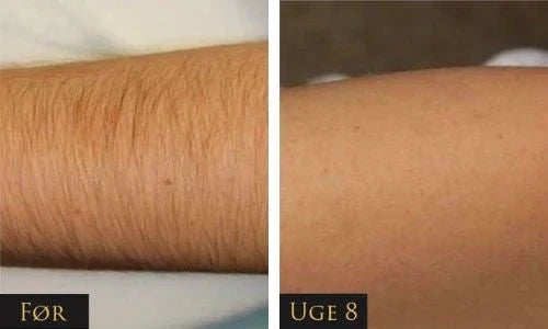 IPL - Épilation permanente