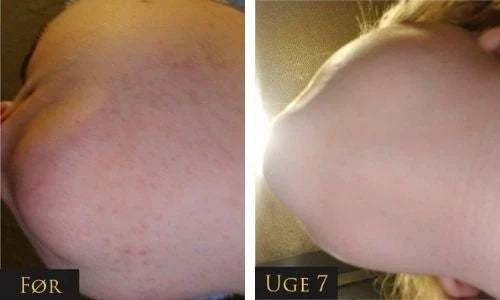 IPL - Épilation permanente